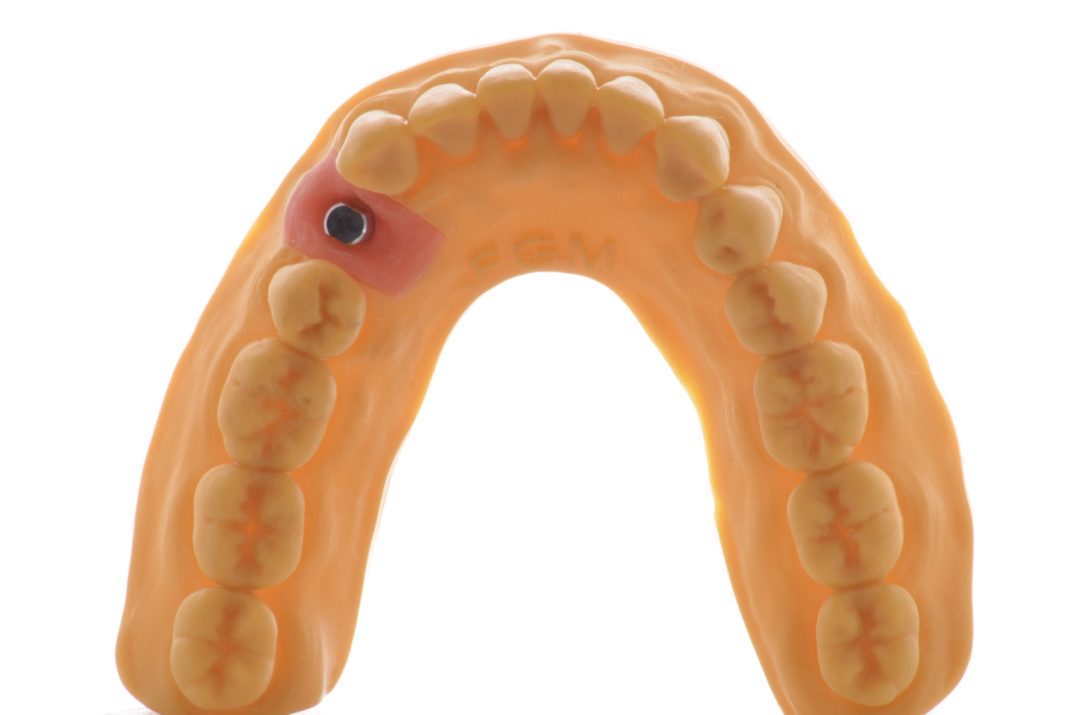 Fig. 14d - Acomode a gengiva artificial no modelo para dar sequencia ao trabalho protético