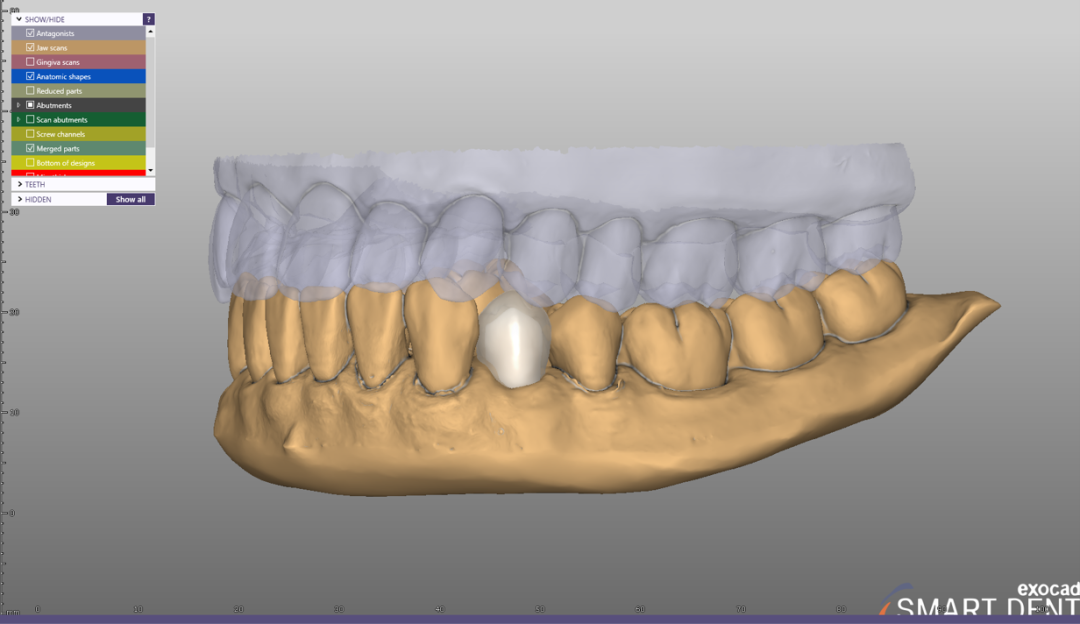 Fig. 15 - Embora existam diversas formas e diferentes materiais para confecção protética, para este caso, uma infra estrutura foi encerada digita