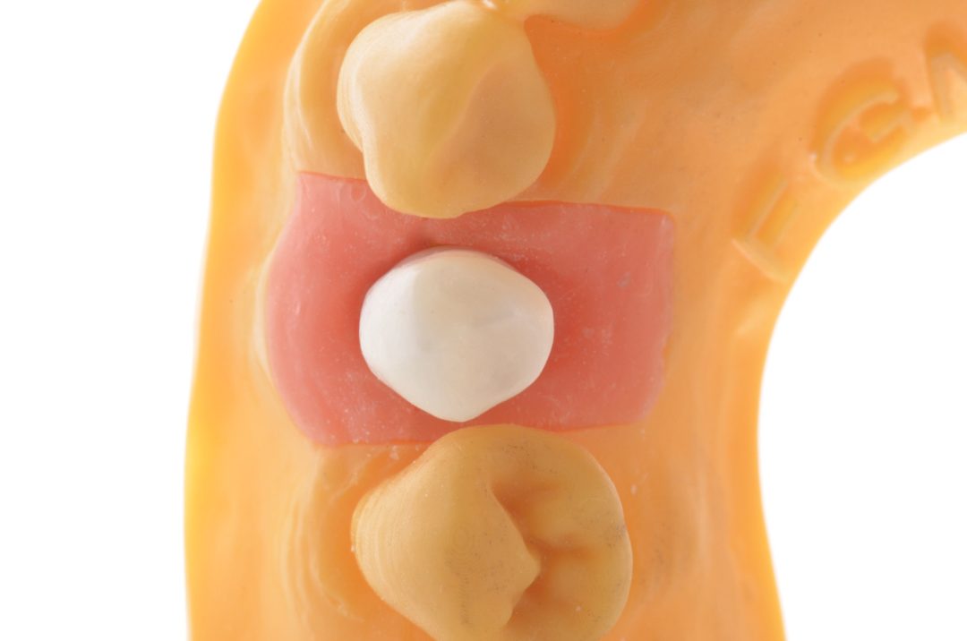 Fig. 18 - Infraestrutura posicionada sobre munhão 4,2x4mm