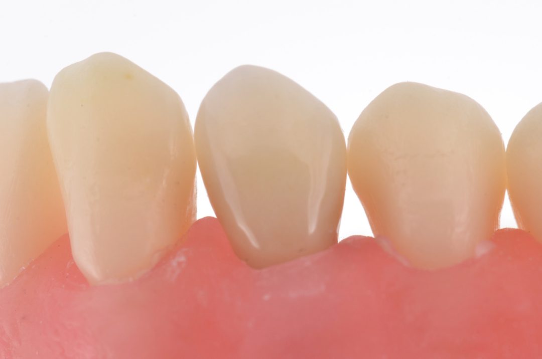 Fig. 19 - Prova da peça cerâmica sobre munhão 4,2x4mm fluxo digital