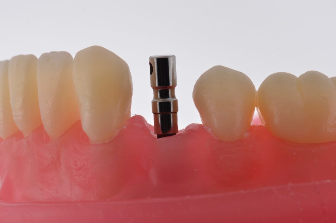 Fig. 2 - Posicione o medidor, para selecionar a altura transmucosa do componente protético