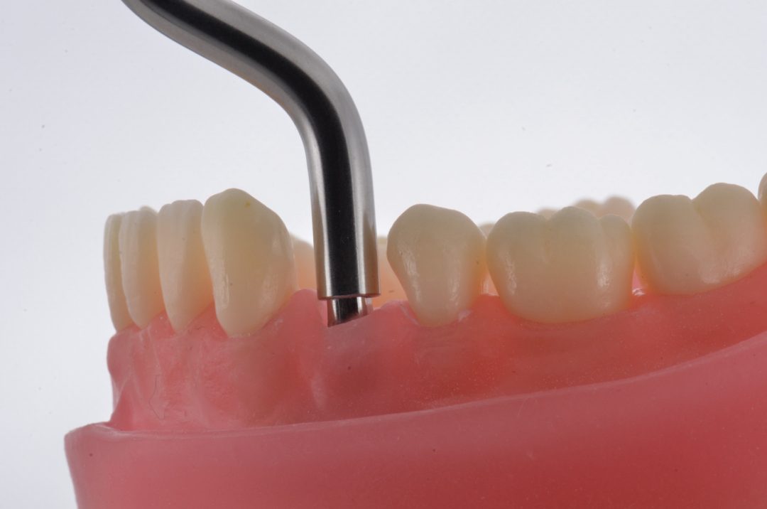 Fig. 3 - Munhão Arcsys 4,2x4x3,5 instalado