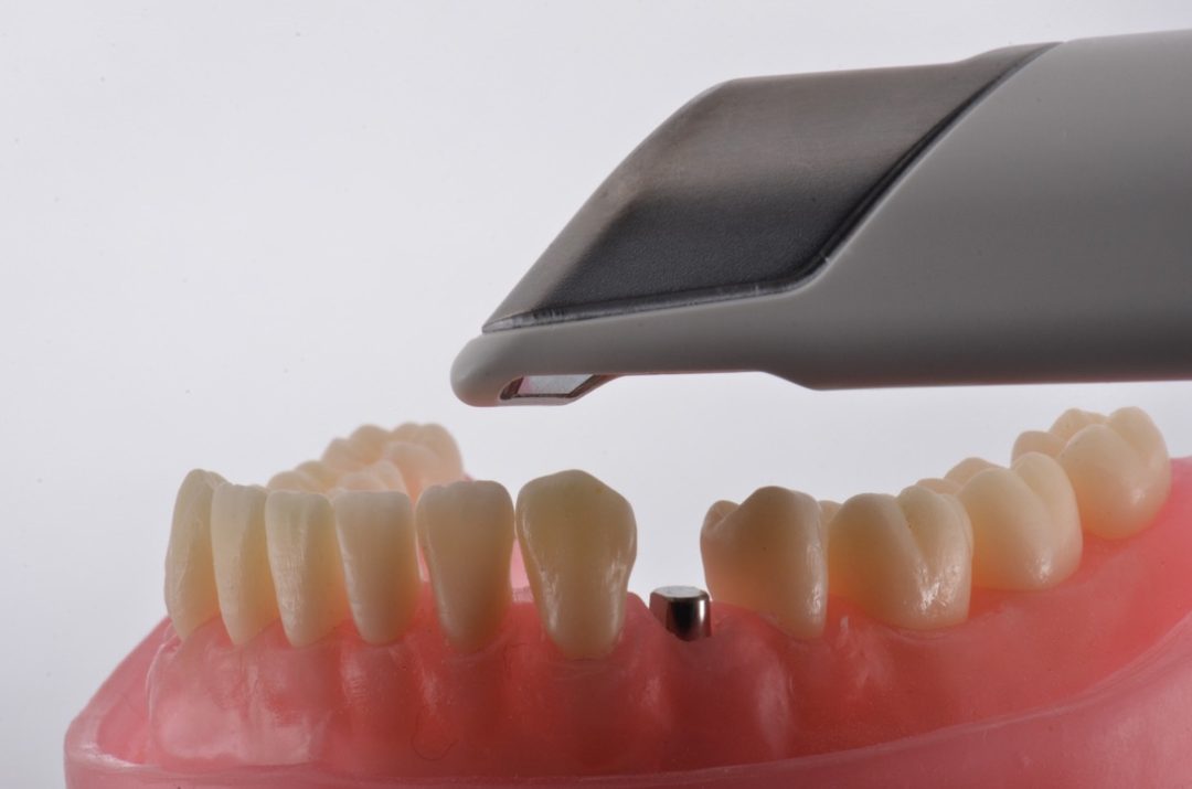 Fig. 4 - Realize o escaneamento inicialmente sem o Scanbody, visando capturar com precisão o condicionamento tecidual obtido