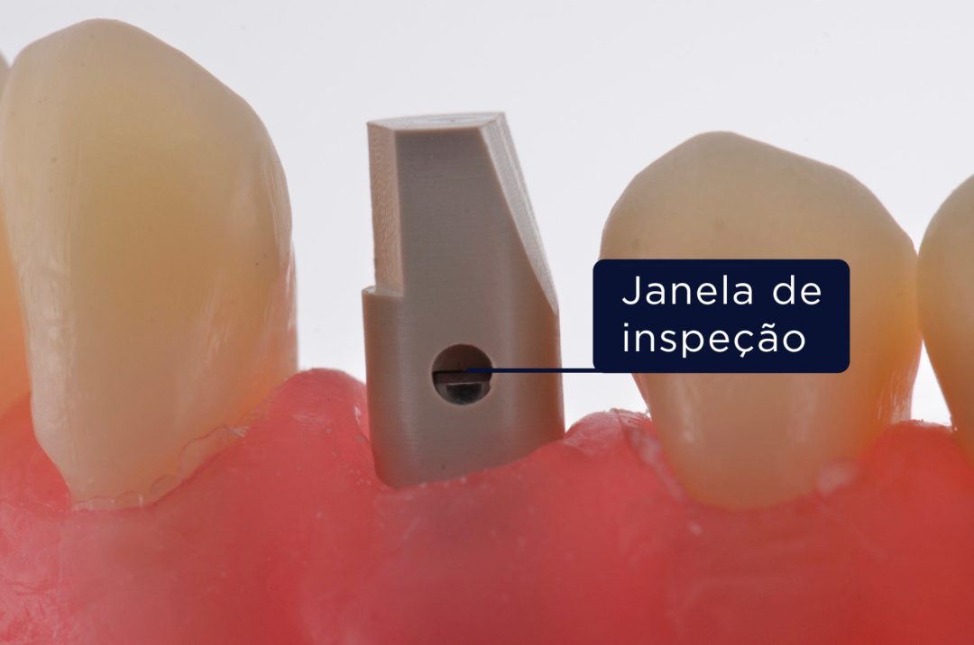 Fig. 6 - Scan Body corretamente posicionado sobre munhão 4,2X4mm-2