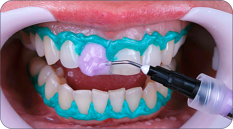 04.png - E-books de Clareamento