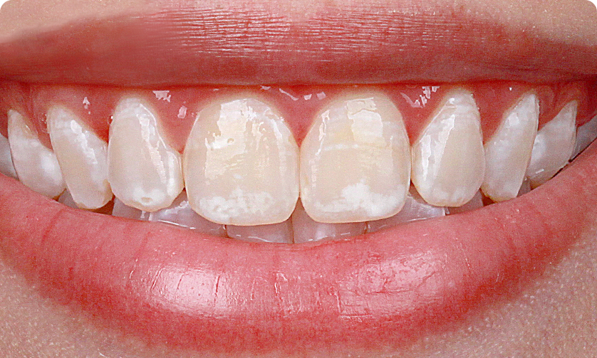 capa caso clinico - Especialista Whiteness - Home