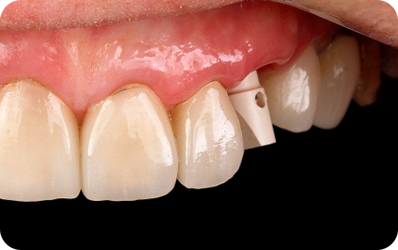 caso implant club 1 - Implant Club