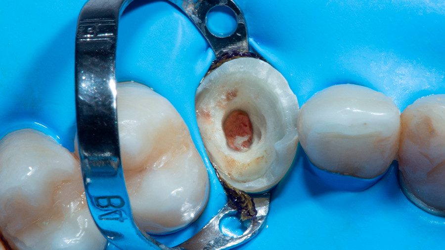 04 - Linha Endodontia