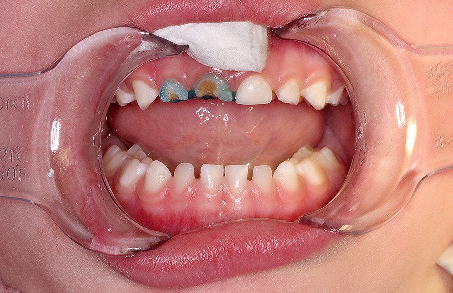 caso05 images1 - Linha Odontopediatria