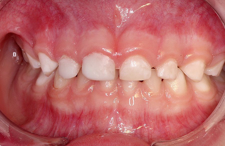 caso05 images7 - Linha Odontopediatria