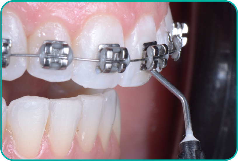dente capa - Ortho Line