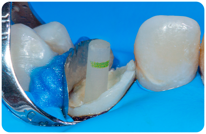 pino - Linha Endodontia