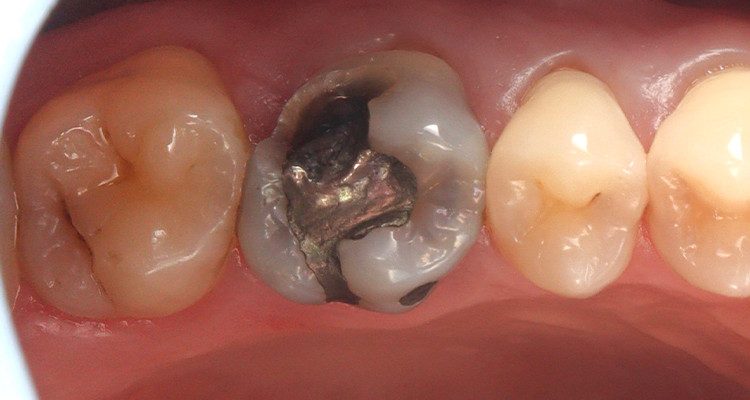 1 | Aspecto inicial da restauração em amálgama com fratura de cúspide mesiodistal.
