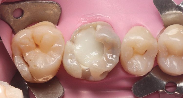 10 | Aspecto da resina Vittra APS Unique após fotopolimerização.