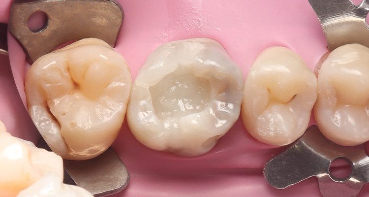 11 | Reconstrução da parede vestibular com Vittra APS Unique . 