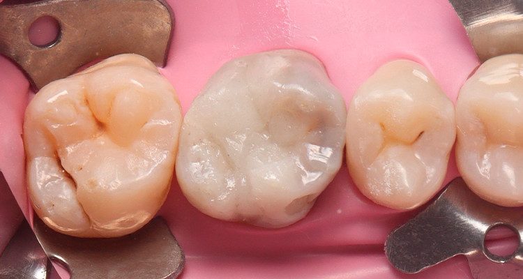 12 | Escultura da superfície oclusal com Vittra APS Unique.