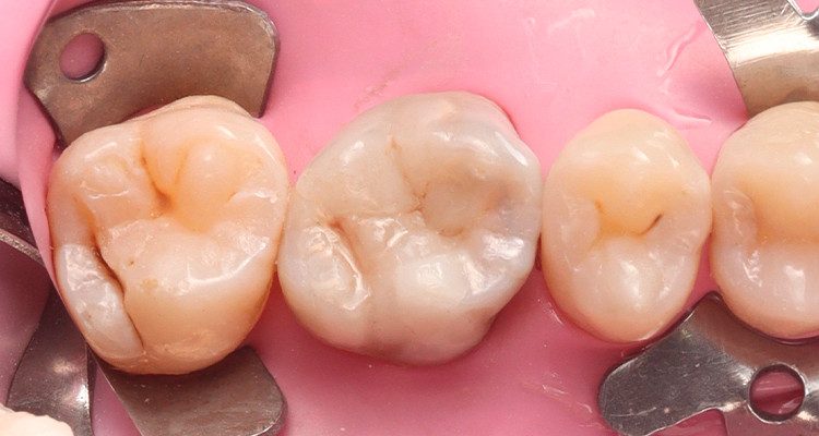 13 | Aspecto após fotopolimerização completa e acabamento.