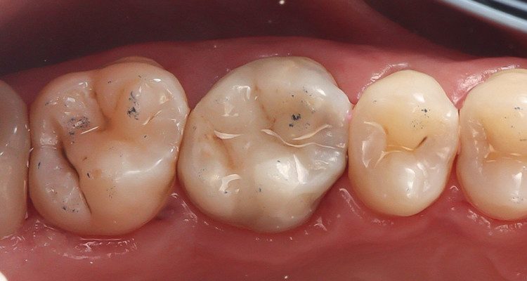 14 | Ajuste oclusal e polimento da restauração.