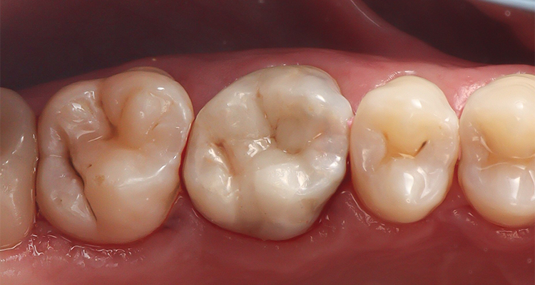 15 | Aspecto final após polimento.