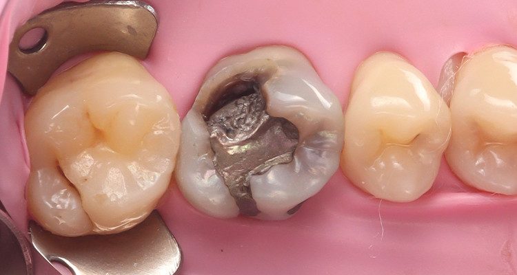 2 | Isolamento absoluto do campo operatório.