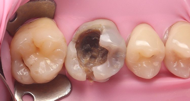 3 | Aspecto da cavidade após remoção da restauração de amálgama, parede pulpar e adjacentes escurecidas