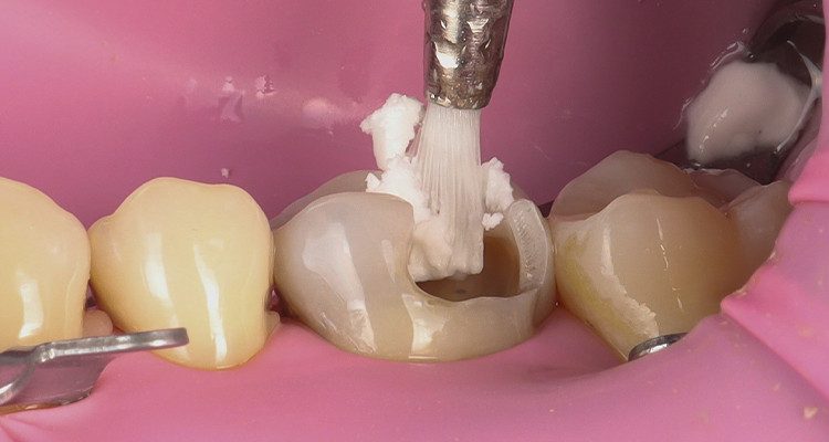 4 | Limpeza da cavidade com auxílio de escova e pasta de pedrapomes e água