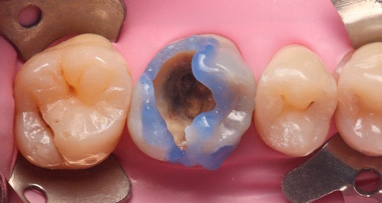 5 | Condicionamento ácido seletivo em esmalte com Condac 37 por 30 segundos. 