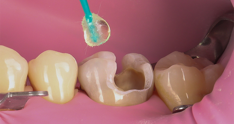 6 | Aplicação ativa do adesivo Ambar Universal APS Plus em toda cavidade por 10 segundos, seguido de volatização e fotopolimerização por 20 segundos