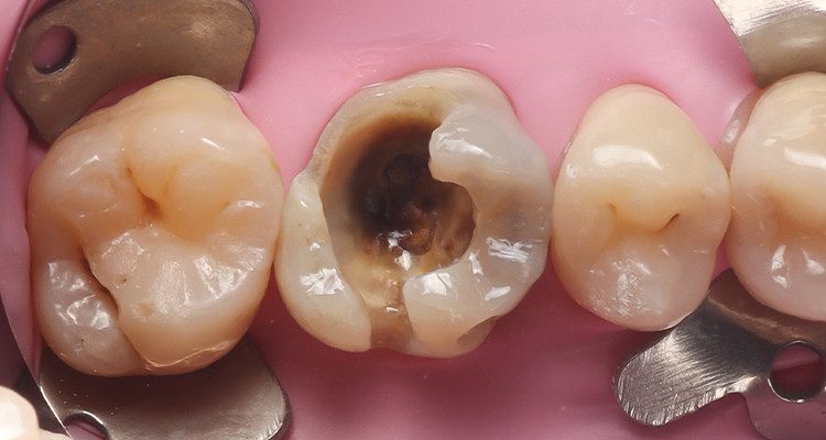 7 | Aspecto da cavidade após polimerização do adesivo.