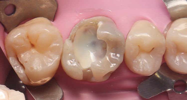 8 | Aplicação de uma fina camada de resina opacificadora Assist APS Opaquer, cor universal, na parede pulpar e adjacentes.