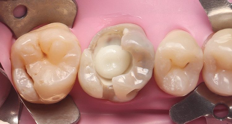 9 | Incremento inicial com a utilização da resina Vittra APS Unique.