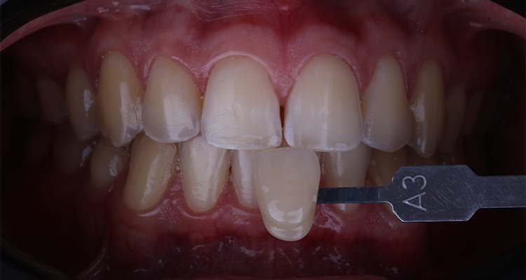 1 | Tomada de cor inicial com a escala de cor, A3 nos incisivos