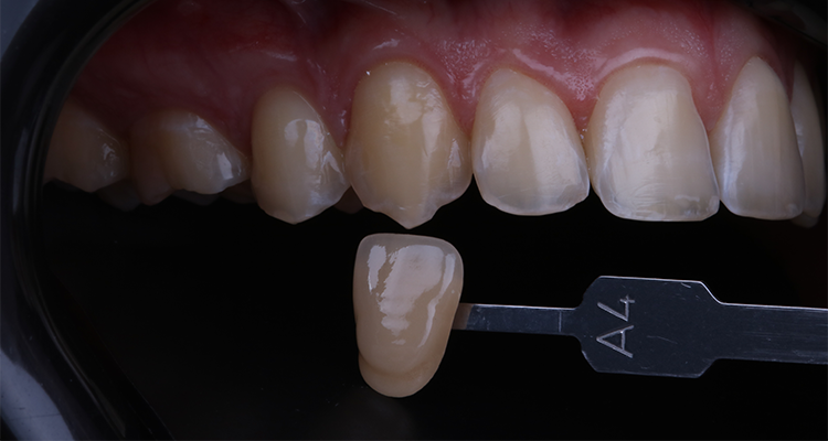 2 | Tomada de cor inicial com a escala de cor, A4 nos caninos.