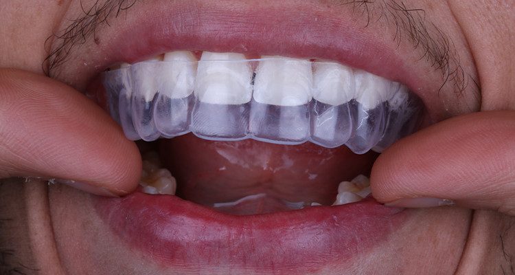 4 | Inserção da moldeira de clareamento