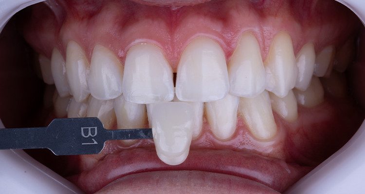 5 | Tomada de cor final com a escala de cor, B1 nos incisivos.