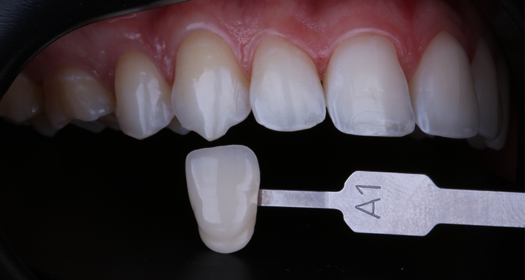6 | Tomada de cor final com a escala de cor, A1 nos caninos