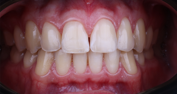 7 | Aspecto intraoral inicial do sorriso