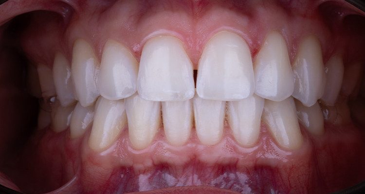 8 | Aspecto intraoral final do sorriso.