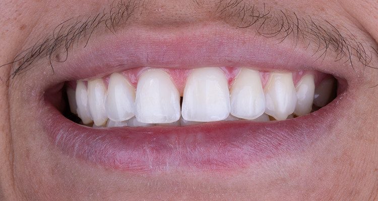 9 | Aspecto final do sorriso.