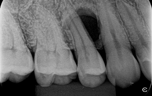 1 | Radiografia periapical inicial revelando uma lesão cística interradicular