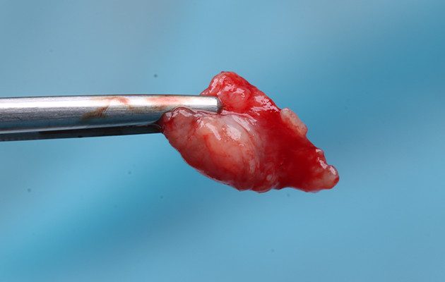 10 | Fragmento tecidual a ser submetido à análise anatomopatológica