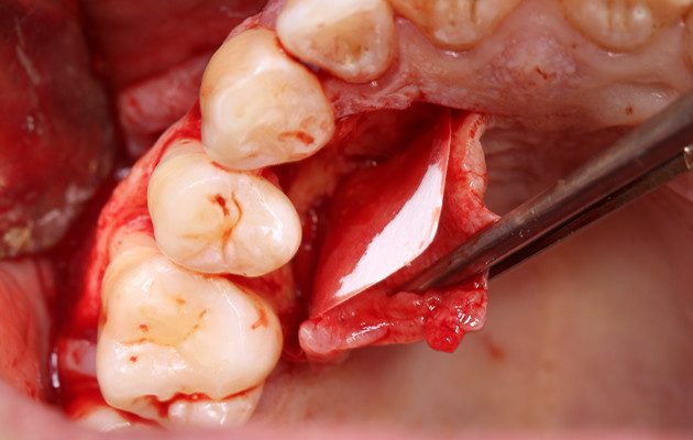 11 | Utilização de membrana sintética (Duosynt).