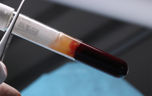 12 e 13 | Sangue venoso centrifugado e biomaterial associado a derivados sanguíneos específicos (steack bone)