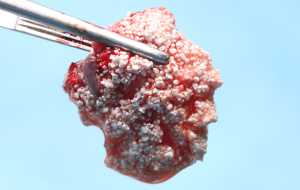 12 e 13 | Sangue venoso centrifugado e biomaterial associado a derivados sanguíneos específicos (steack bone)