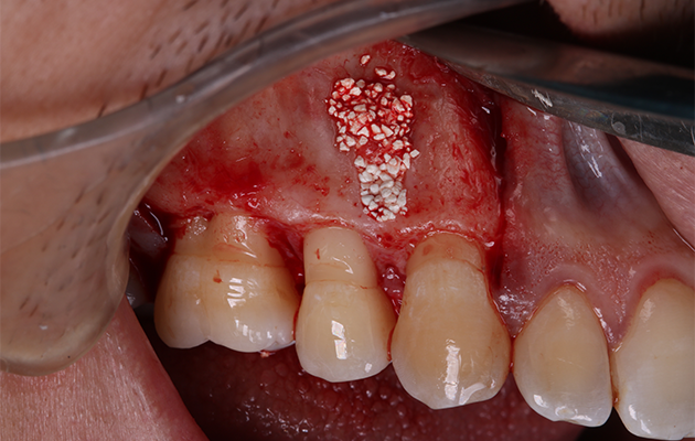 14 | Preenchimento do defeito com Biomaterial