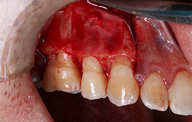 15 | Tamponamento da janela vestibular com Duosynt