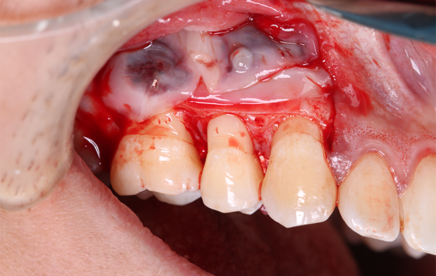 16 | Membranas de L-PRF comodadas sobre a membrana sintética.