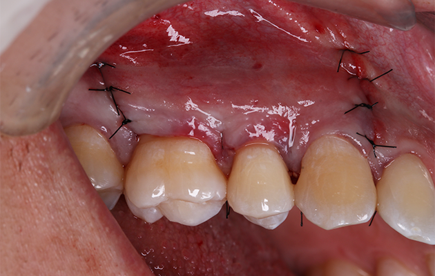 17 | Síntese. regeneração óssea