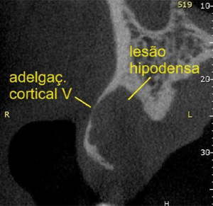 2, 3 e 4 | Diferentes planos tomográficos, evidenciando a real extensão da lesão.