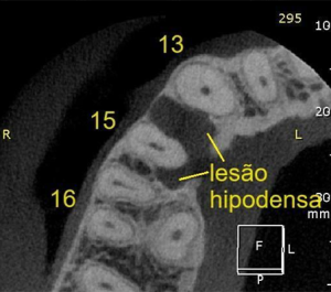 2, 3 e 4 | Diferentes planos tomográficos, evidenciando a real extensão da lesão.